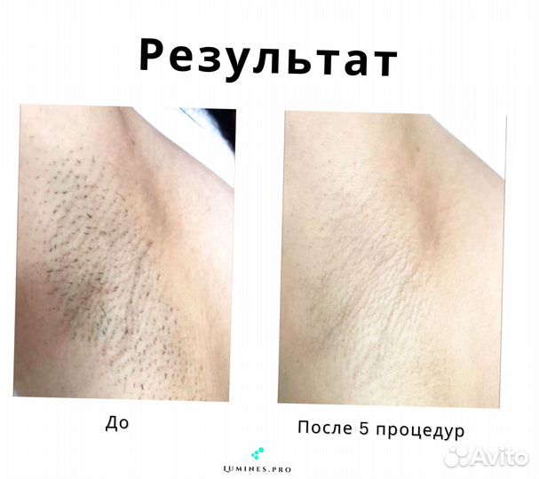 Диодный лазер Lumines Max'One 1200w 2024