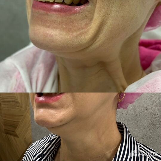 Лифтинг нефертити/ безопасная подтяжка овала лица