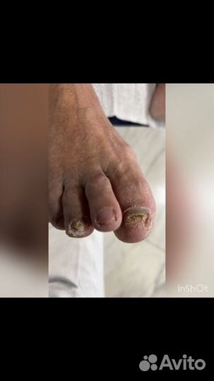 Лечение грибка ногтей