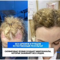Пересадка волос с гарантией Верните густые волосы, Майкоп