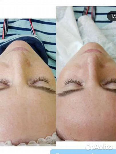 Шугаринг на дому сахарной пастой