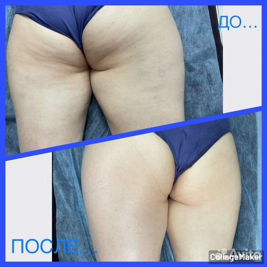 Lpg массаж (аппаратный массаж)