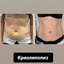 Криолиполиз похудение, Майкоп