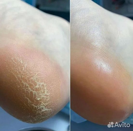 Обрезной педикюр, наращивание и коррекция ногтей