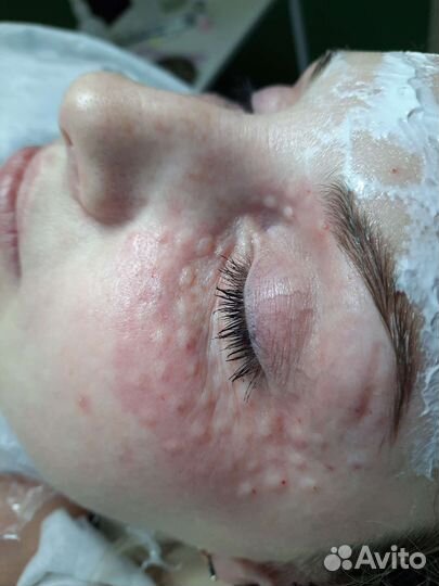 Мезотерапия, Биоревитализация глаз, лица, шеи