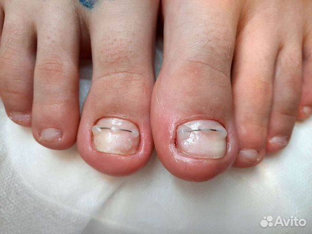 Медицинский педикюр. Профессиональный