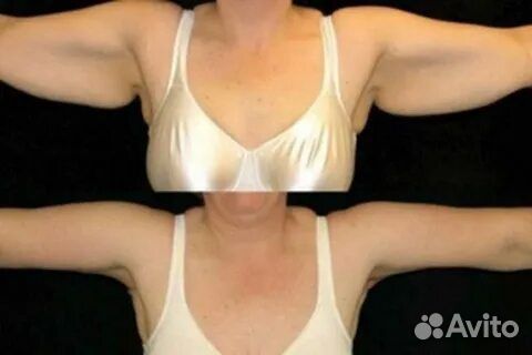 Подтянуть обвисшие руки. Худые руки