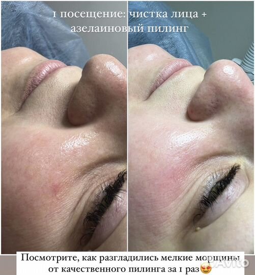 Чистка лица + пилинг в подарок