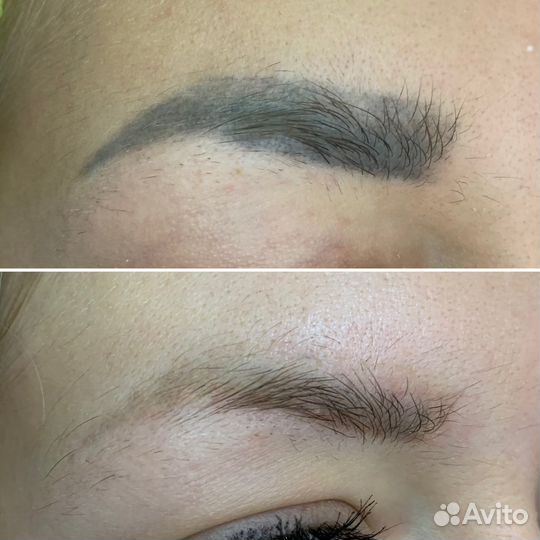 Удаление татуажа бровей модель