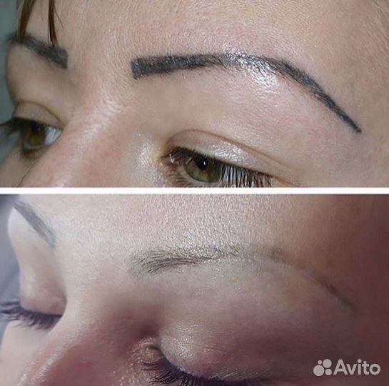 Удаление татуажа