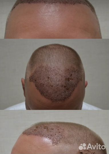 Пересадка волос / Бесплатная консультация