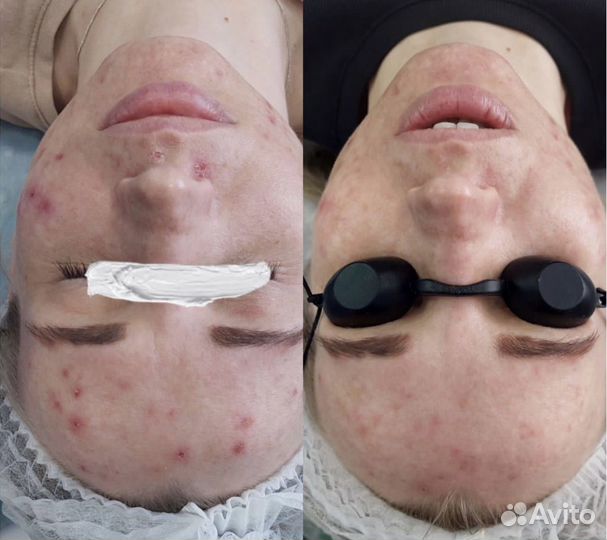 Фототерапия на аппарате М22