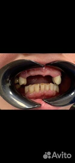 Зубной техник съемное протезирование