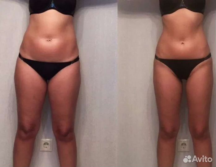 Аппаратный вакуумный массаж, турбо, кавитация