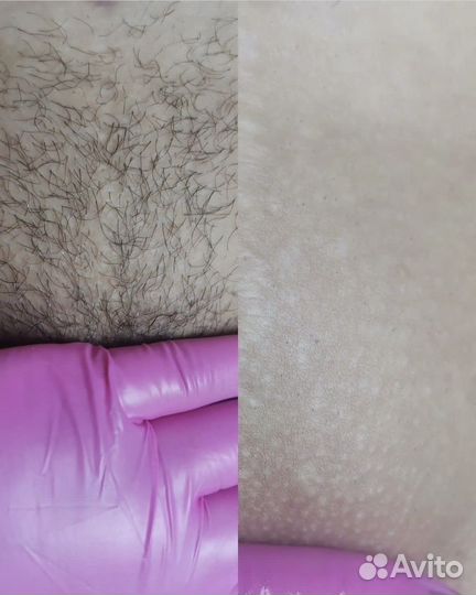 Обучение шугаринг,депиляция