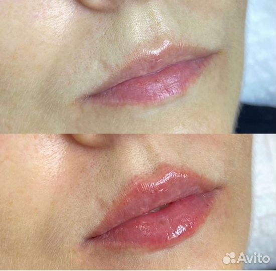 Увеличение губ