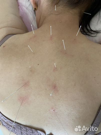 Иглотерапия