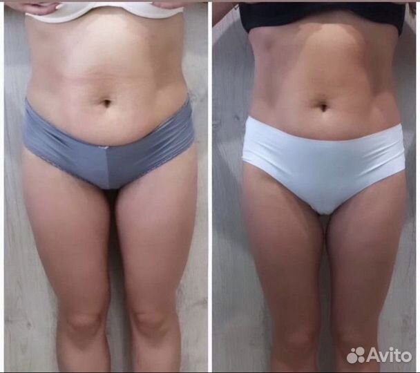 LPG массаж в Новороссийске