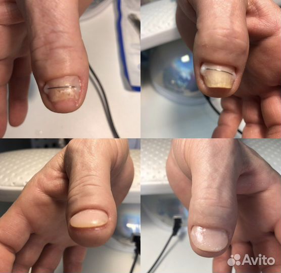 Подолог, титановые нити