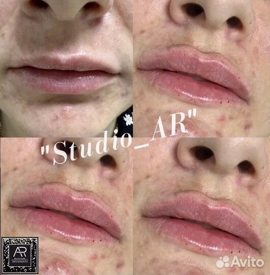 Увеличение губ. Обучение