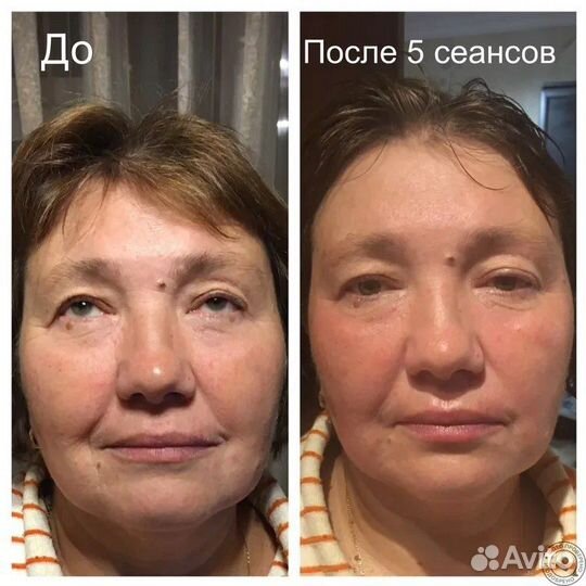 Буккальный массаж