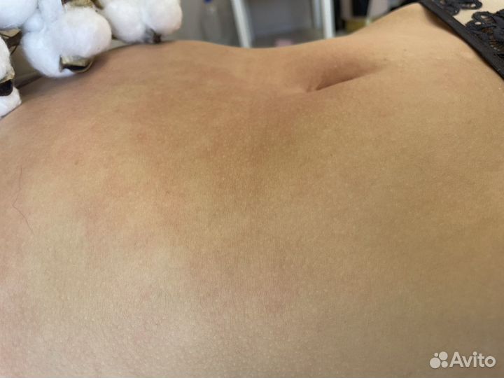 Депиляция воском: глубокое бикини