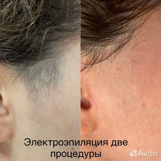 Чистки/пилинги,микротоки,шугаринг,электроэпиляция