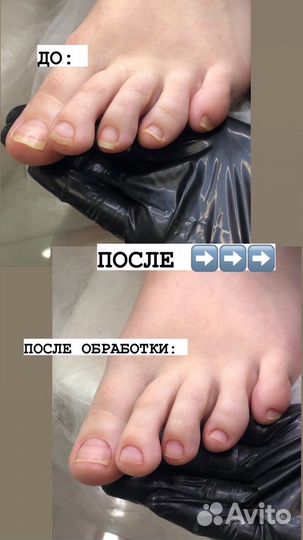 Аппаратный педикюр