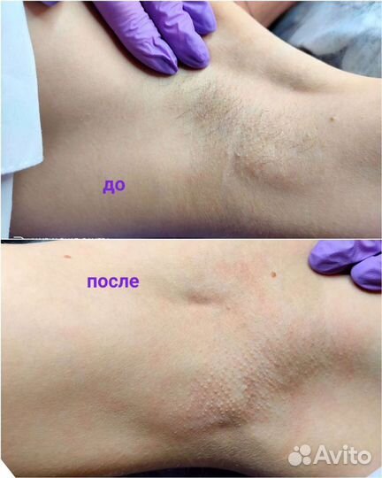 Депиляция Купчино, м.Балканская 42 к 1