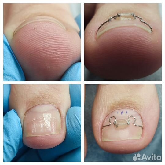 Парамедицинский педикюр, подолог