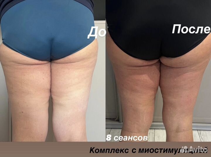 Аппаратный массаж