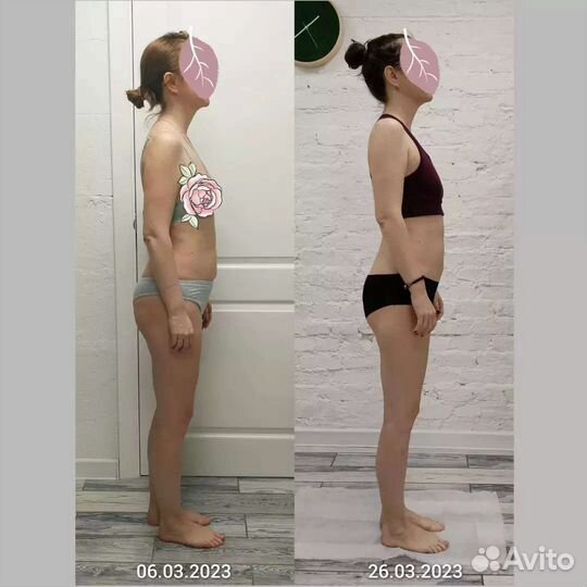 Остеопластика, биодинамика