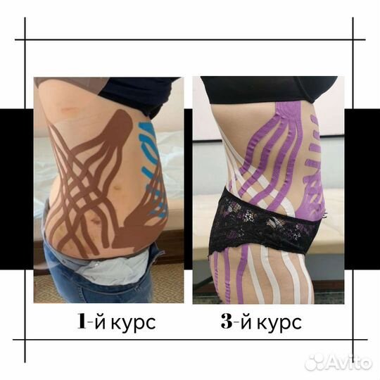 Коррекция фигуры, похудение, тейпирование