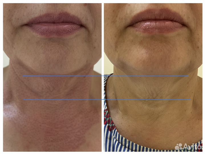 Омоложение кожи горячей плазмой, подтяжка кожи