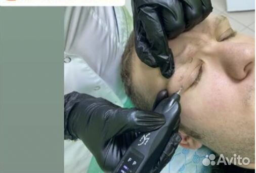 Удаление новообразований (папиллом)