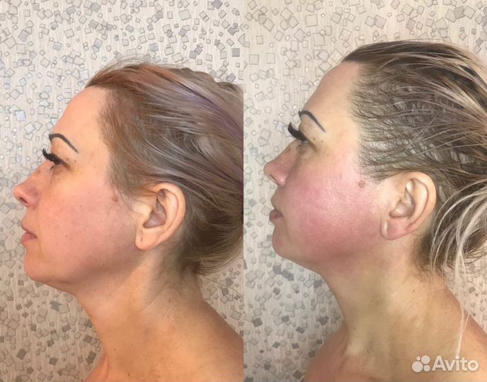 Массаж лица