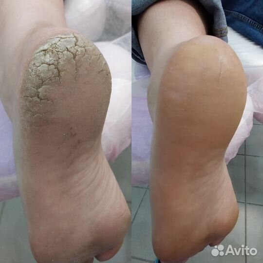 Аппаратный педикюр