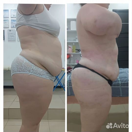 Массаж. Аппаратная коррекция фигуры. Снижение веса