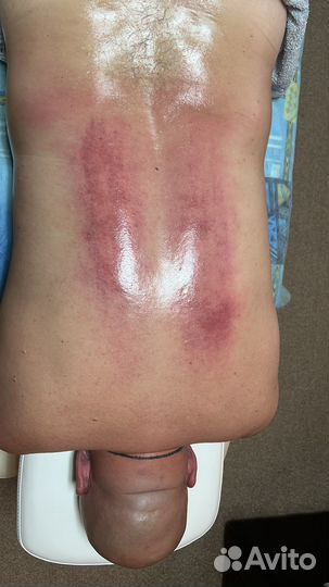 Миофасциальный массаж, миопрессура