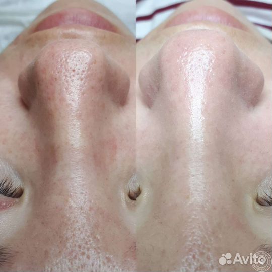 Комбинированная чистка лица