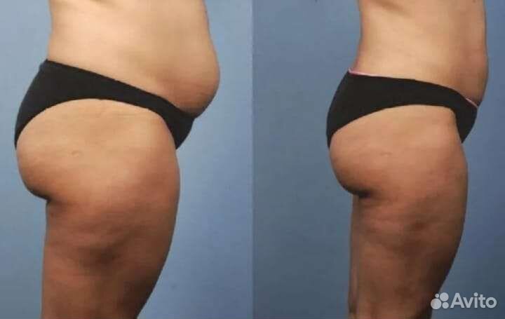 Коррекция фигуры