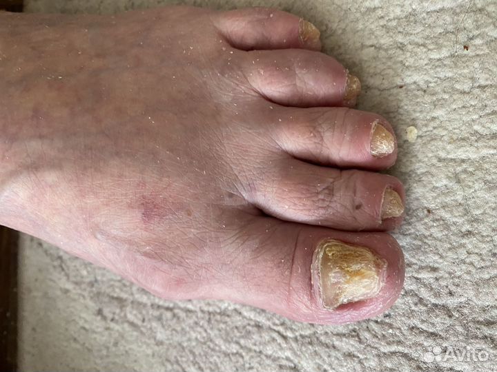 Педикюр подолог