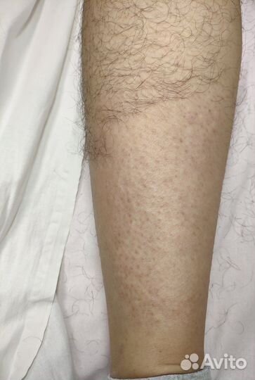 Электроэпиляция: бёдра