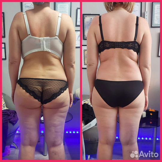 LPG массаж канавино