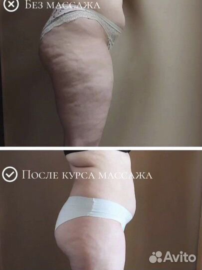 Гидромассаж (подводный вакуумный массаж)