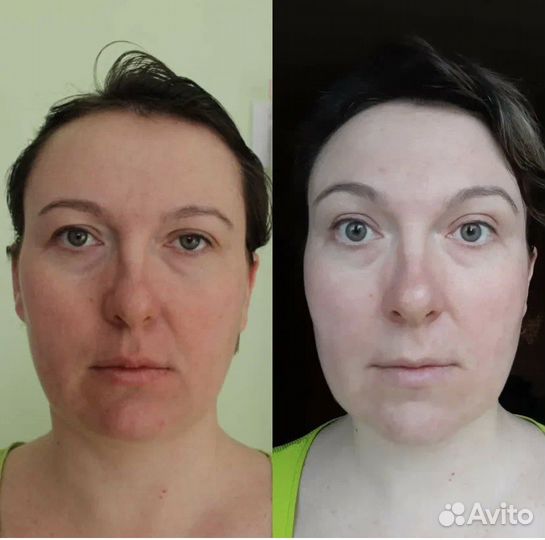 Скульптурно-моделирующий массаж лица