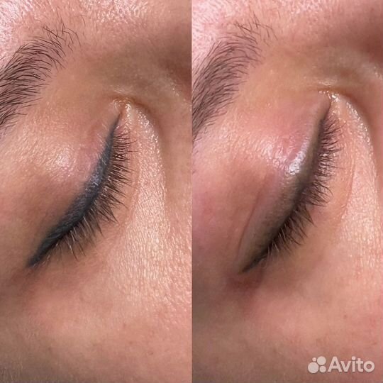 Модели на удаление татуажа лазером