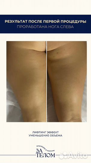 Антицеллюлитный аппаратный массаж