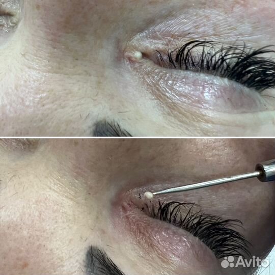 Милиум/Белые угри/Чистка