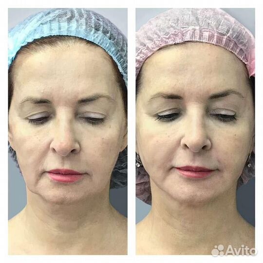 Биоревитализация лица и мезотерапия